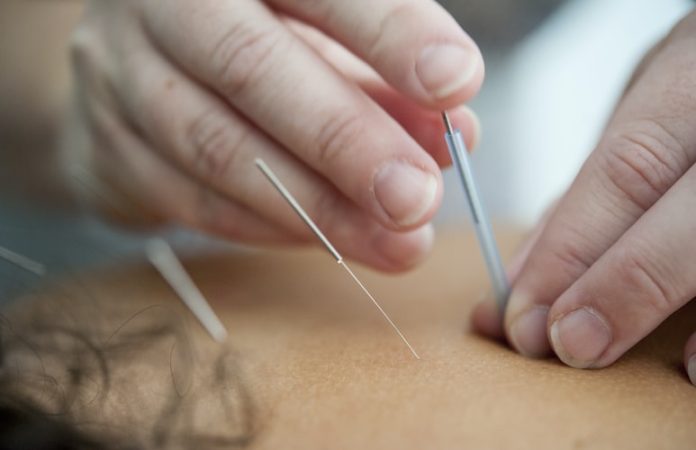 10 Benefits of Acupuncture Treatment